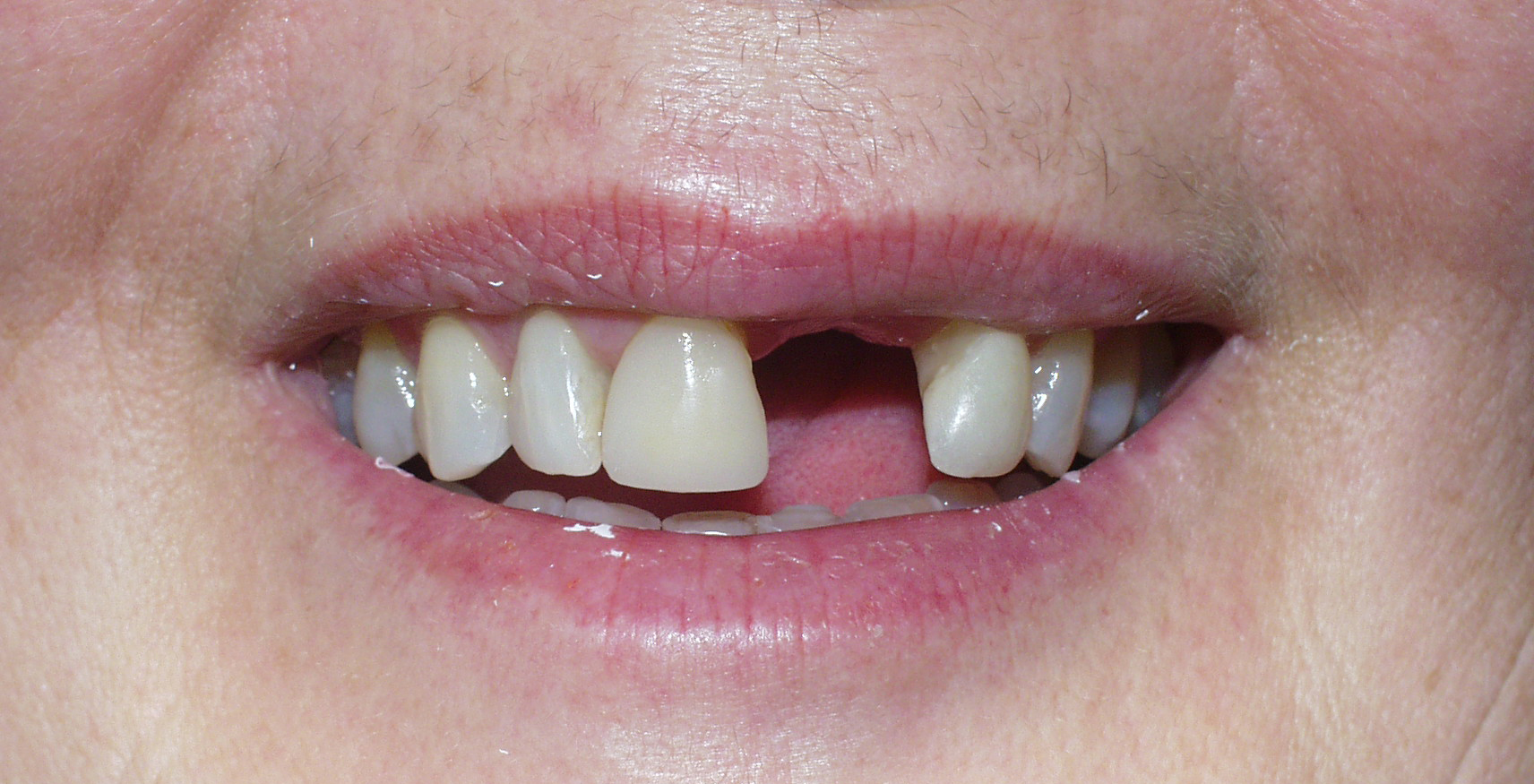 Before Close Up Of A Persons Mouth With Missing Teeth — Dr Patrick Meaney In Moss Vale, NSW