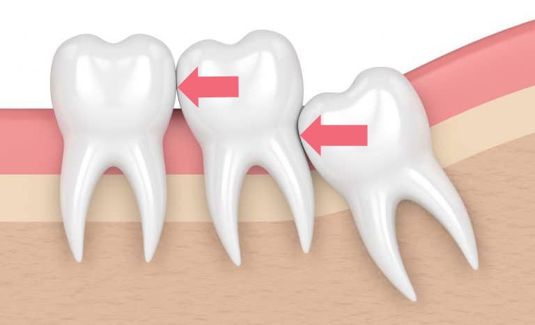 A Group Of Teeth With Red Arrows Pointing To Them — Dr Patrick Meaney In Moss Vale, NSW