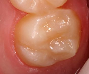 After Close Up Of Chipped Tooth — Dr Patrick Meaney In Moss Vale, NSW