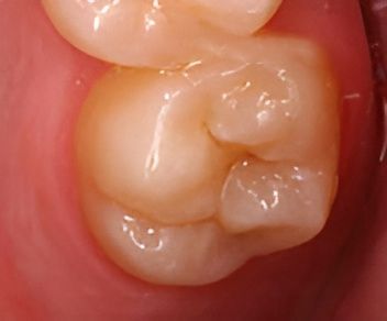 Before Close Up Of Chipped Tooth — Dr Patrick Meaney In Moss Vale, NSW