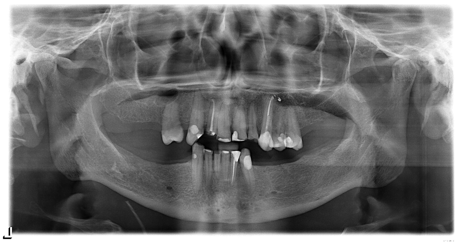 Dentist Showing Teeth Dentures to a Patient — Minnetonka, MN — Cendar Hill Dental Center