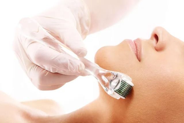 Person Receiving Microneedling Treatment on Their Cheek With a Roller — Body Sanctuary in Anula, NT