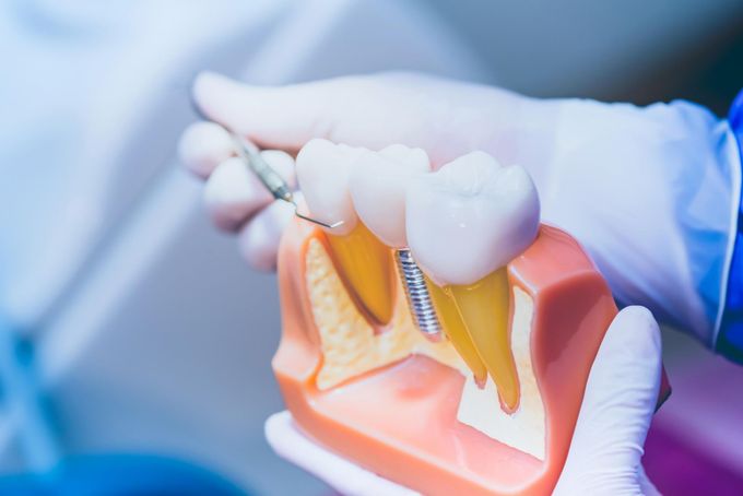 A Dentist is Holding a Model of a Tooth With a Screw in It — Burleigh Heads Denture Clinic Gold Coast in Burleigh Heads, QLD A Dentist is Holding a Model of a Tooth With a Screw in It — Burleigh Heads Denture Clinic Gold Coast in Burleigh Heads, QLD