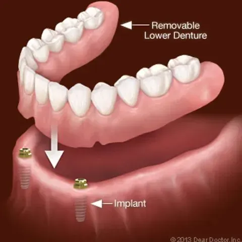 An illustration of a removable lower denture and an implant — Burleigh Heads Denture Clinic Gold Coast in Burleigh Heads, QLD