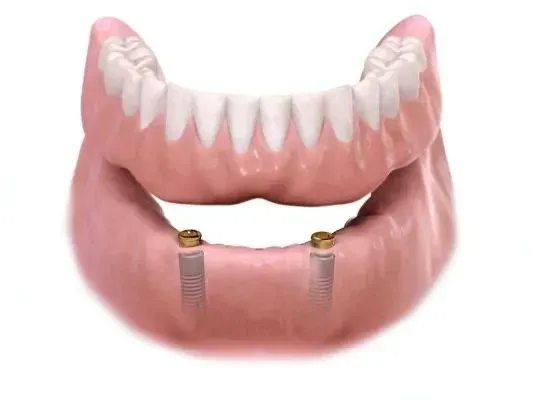 A close up of a denture with two dental implants in it. — Burleigh Heads Denture Clinic Gold Coast in Burleigh Heads, QLD