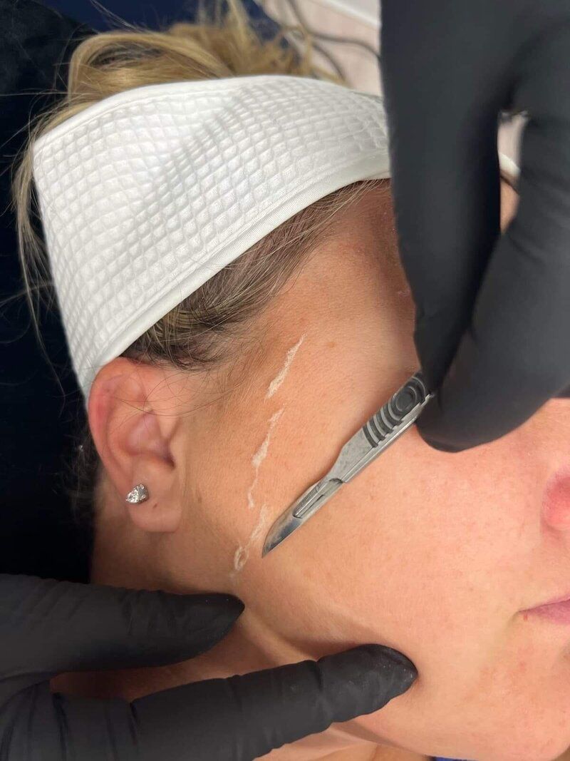 A woman is getting a facial treatment with a scalpel.