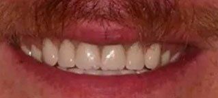 A close up of a man 's mouth with a beard and white teeth.