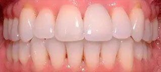 A close up of a person 's teeth with white teeth.