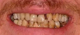 A close up of a man 's teeth with a beard.