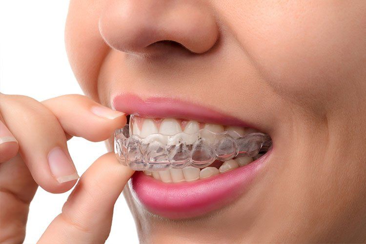 invisalign tray being put inside mouth