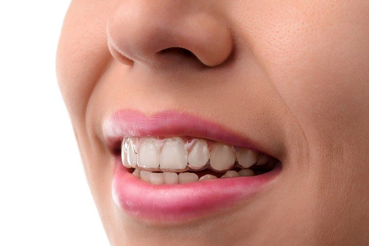 invisalign tray inserted into teeth