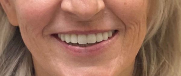 A close up of a woman 's smile with white teeth.