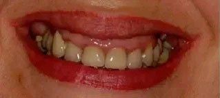 picture of unhealthy and healthy teeth