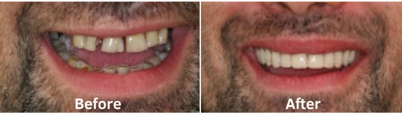 before and after teeth