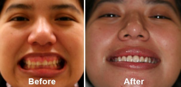 before and after teeth