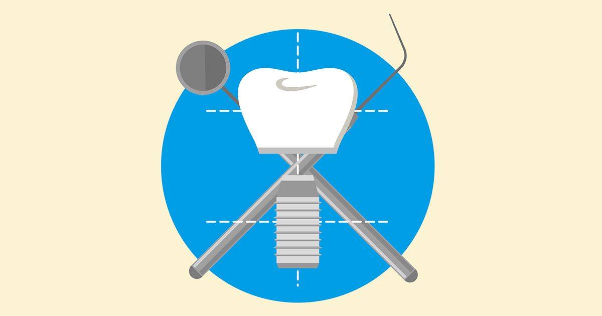 An illustration of a dental implant with a tooth and dental instruments.