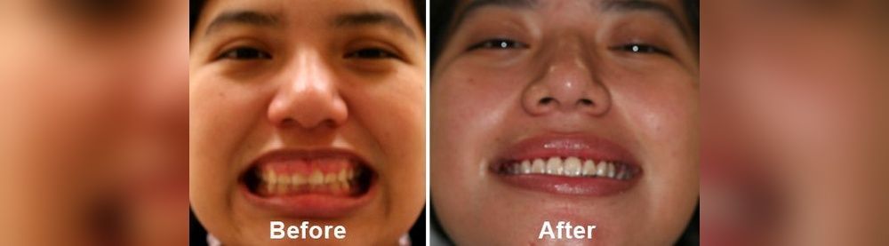 before and after teeth