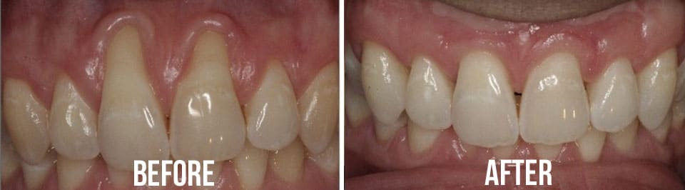 before and after teeth