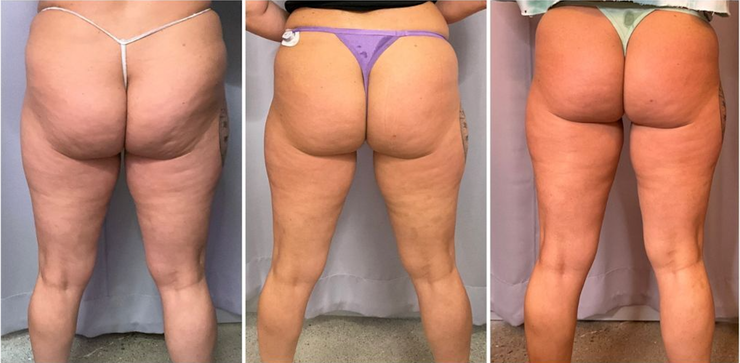 Three rear views of legs and buttocks with cellulite. Three rear views of legs and buttocks with cellulite.