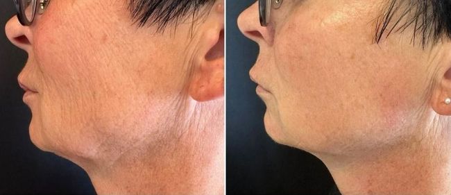 Before and after skin tightening results. Before and after skin tightening results.