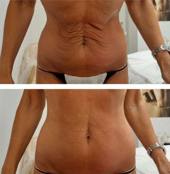 Person's tummy before and after a cosmetic procedure, showing a smoother appearance. Person's tummy before and after a cosmetic procedure, showing a smoother appearance.