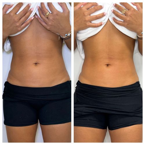 Before and after skin tightening results. Before and after skin tightening results.