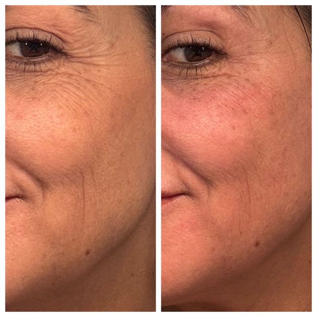 Before and after skin tightening results. Before and after skin tightening results.