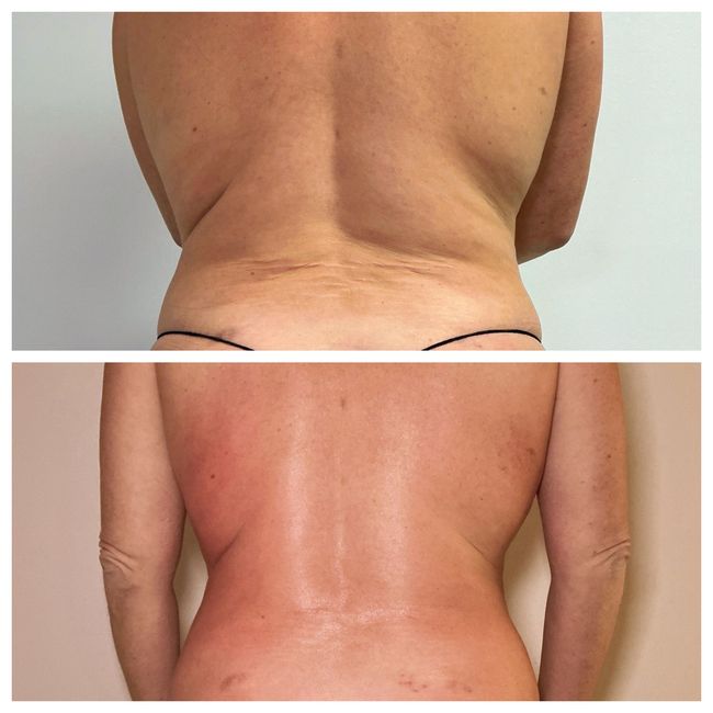 Person's buttocks before and after a cosmetic procedure. T-Shape 2 before and after back and flank contouring