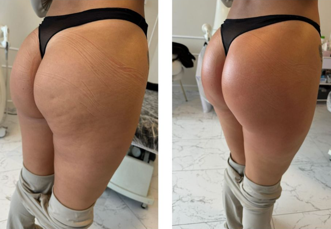 Person's buttocks before and after a cosmetic procedure. Person's buttocks before and after a cosmetic procedure.