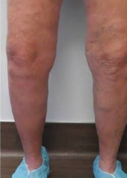 A photo of legs after varicose veins treatment.