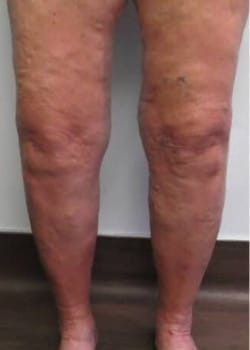 A photo of legs before varicose veins treatment.