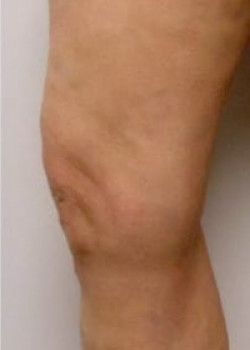 A close up of a person's leg after varicose veins treatment.