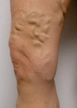 A close up of a person's leg before varicose veins treatment.