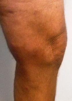 A person's leg after varicose veins treatment.