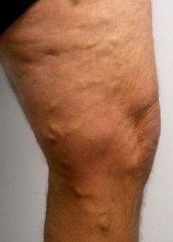 A person's leg before varicose veins treatment.