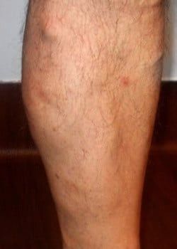 A photo of a man's leg after varicose veins treatment.