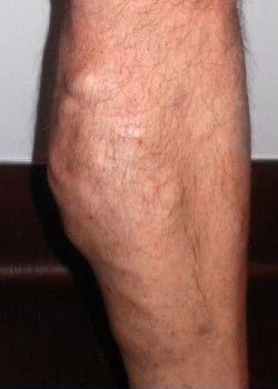 A photo of a man's leg before varicose veins treatment.