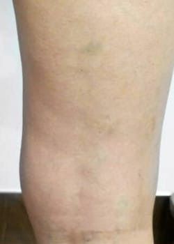 A woman's leg with after varicose veins treatment.