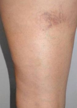 A woman's leg with before varicose veins treatment.