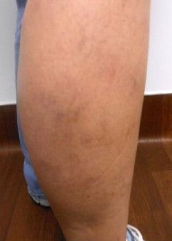 A close up of a person's leg after treatment of varicose veins.