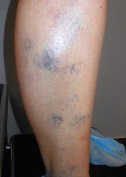 A close up of a person's leg before treatment of varicose veins.