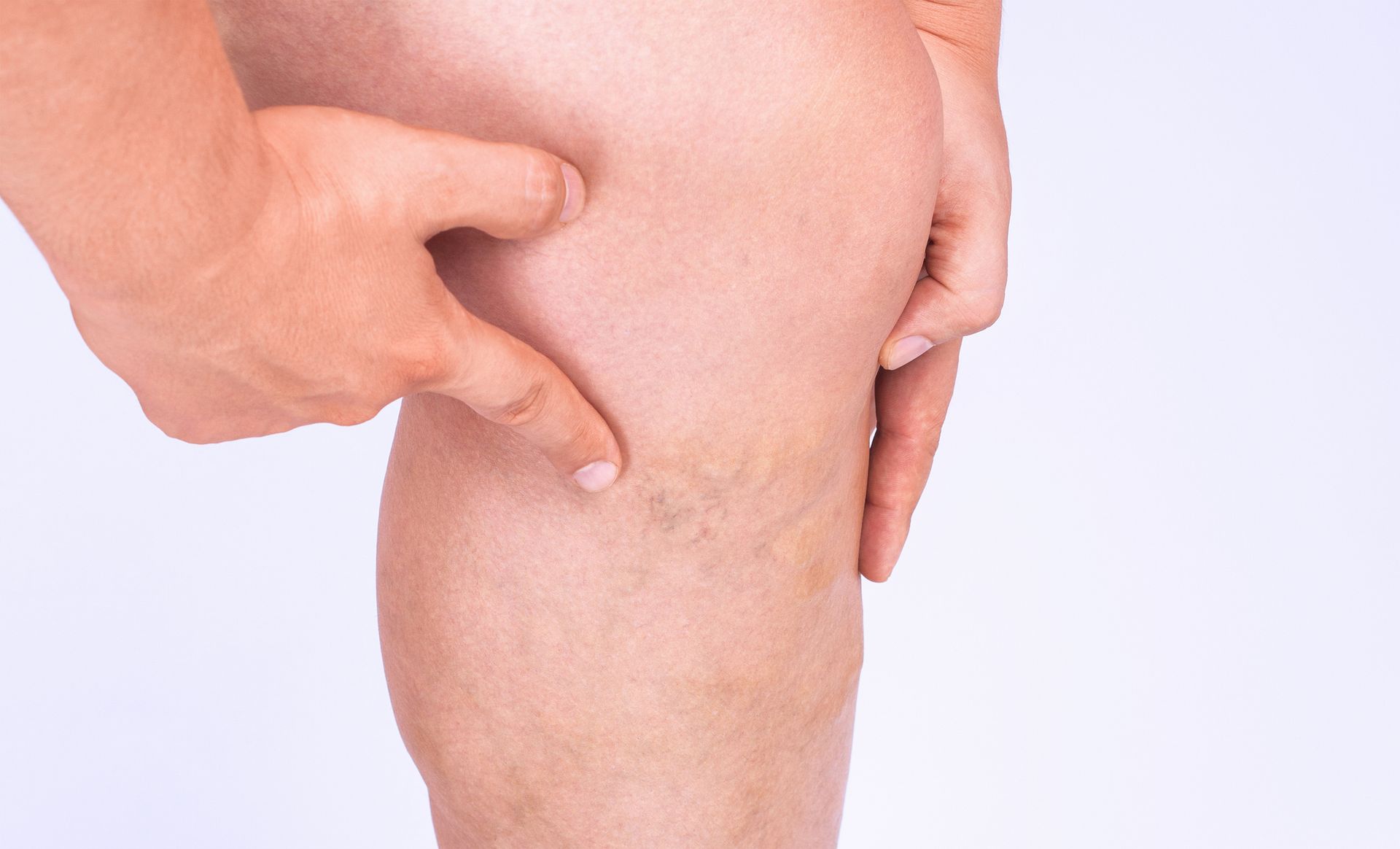A man is holding his leg with varicose veins.