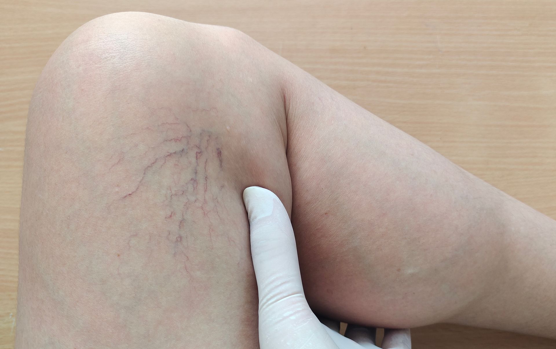 A person wearing a glove is touching a woman 's leg with varicose veins.