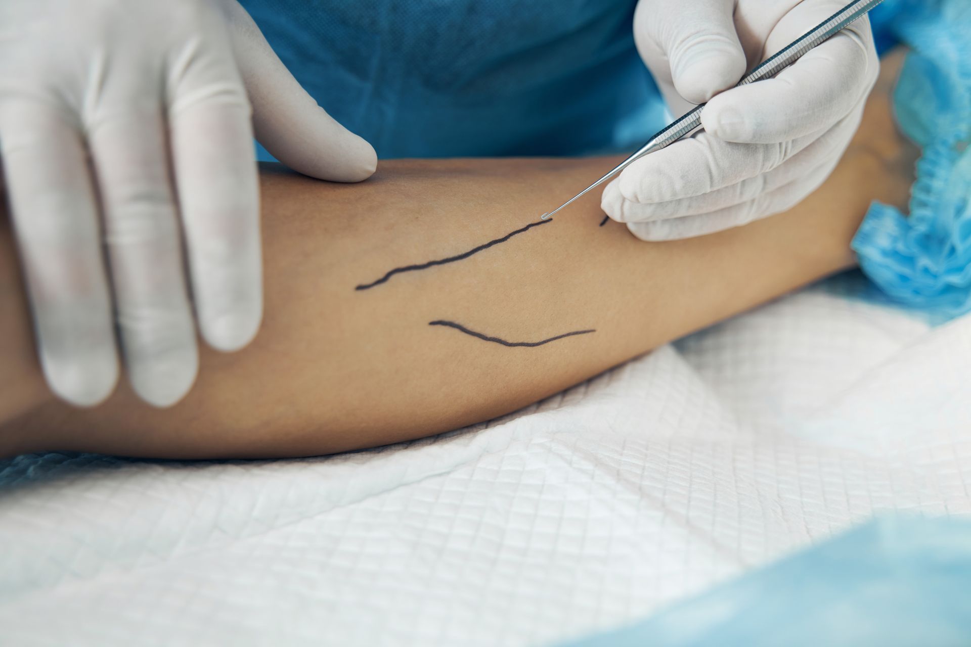 Medical inspection of varicose veins. Medical inspection of varicose veins.