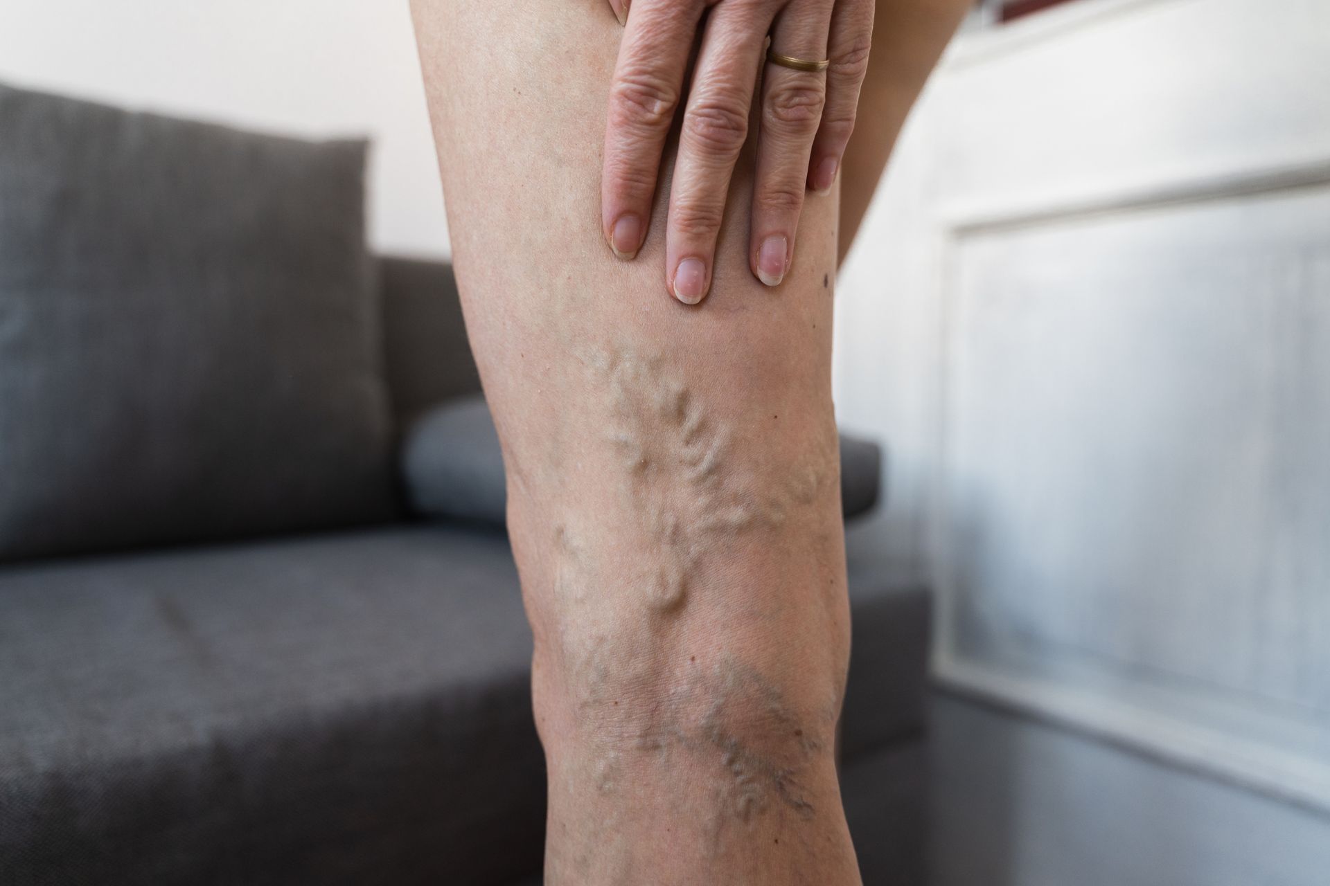 Close-up of a person's leg with varicose veins and hand resting on it. Close-up of a person's leg with varicose veins and hand resting on it.