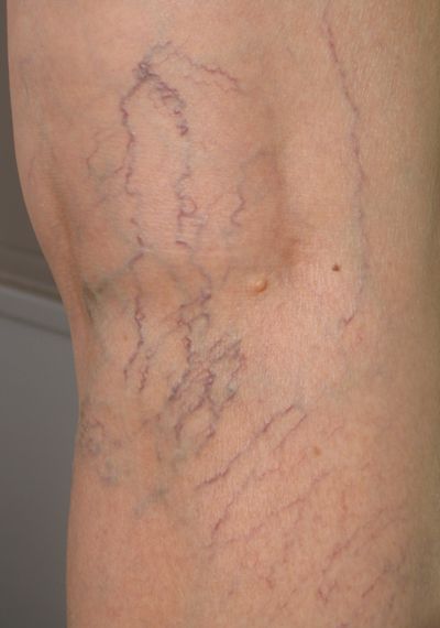 Close-up view of varicose veins on a fair-skinned leg, taken from behind the knee.