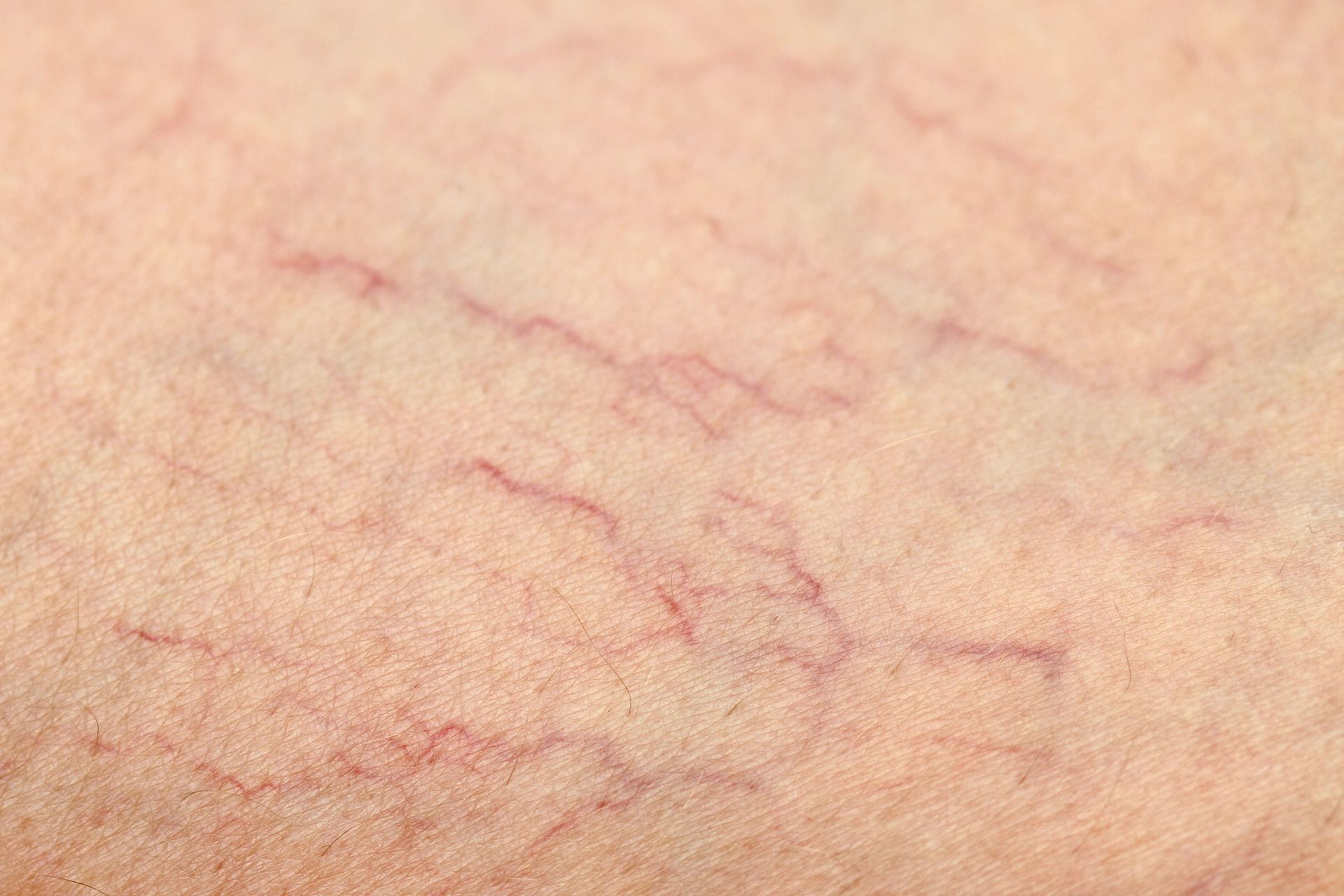Closeup of spider veins in a patient’s leg