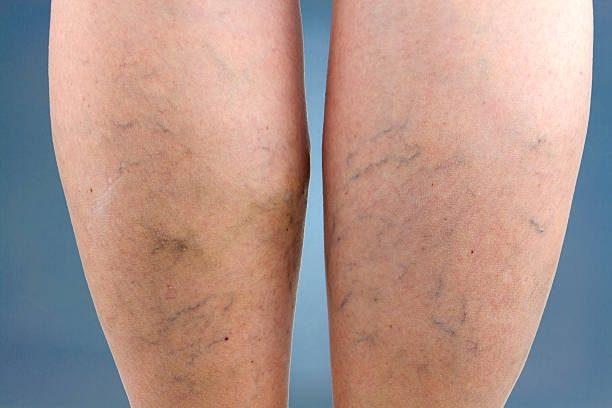 A close up of a woman 's legs with varicose veins.