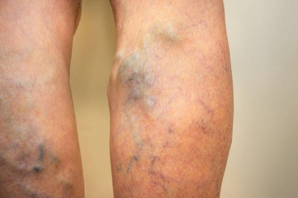 A close up of a person's leg with varicose veins.