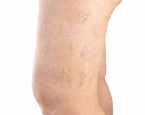 Close-up of female leg with varicose veins, with a white as background.